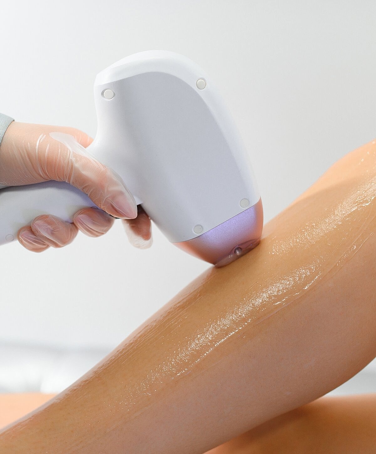Laser hair removal treatment on a leg.
