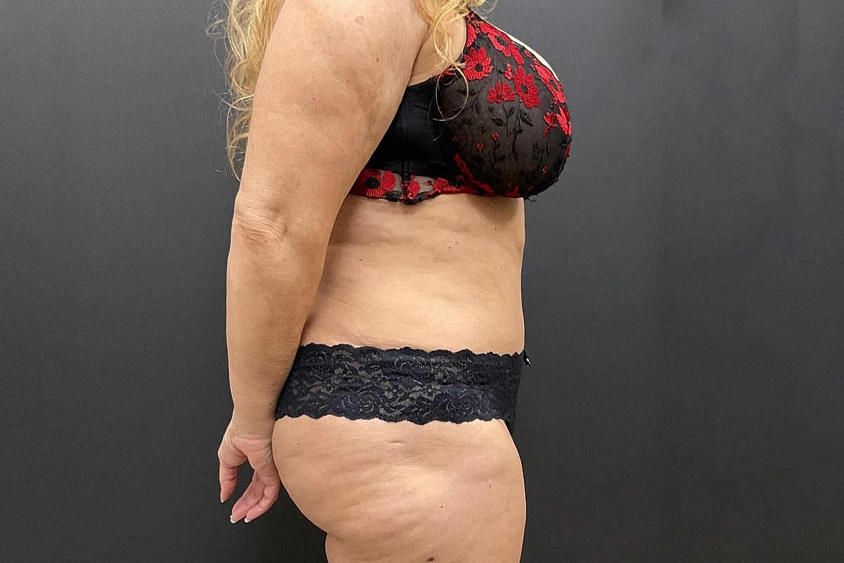 Tummy Tuck Before & After