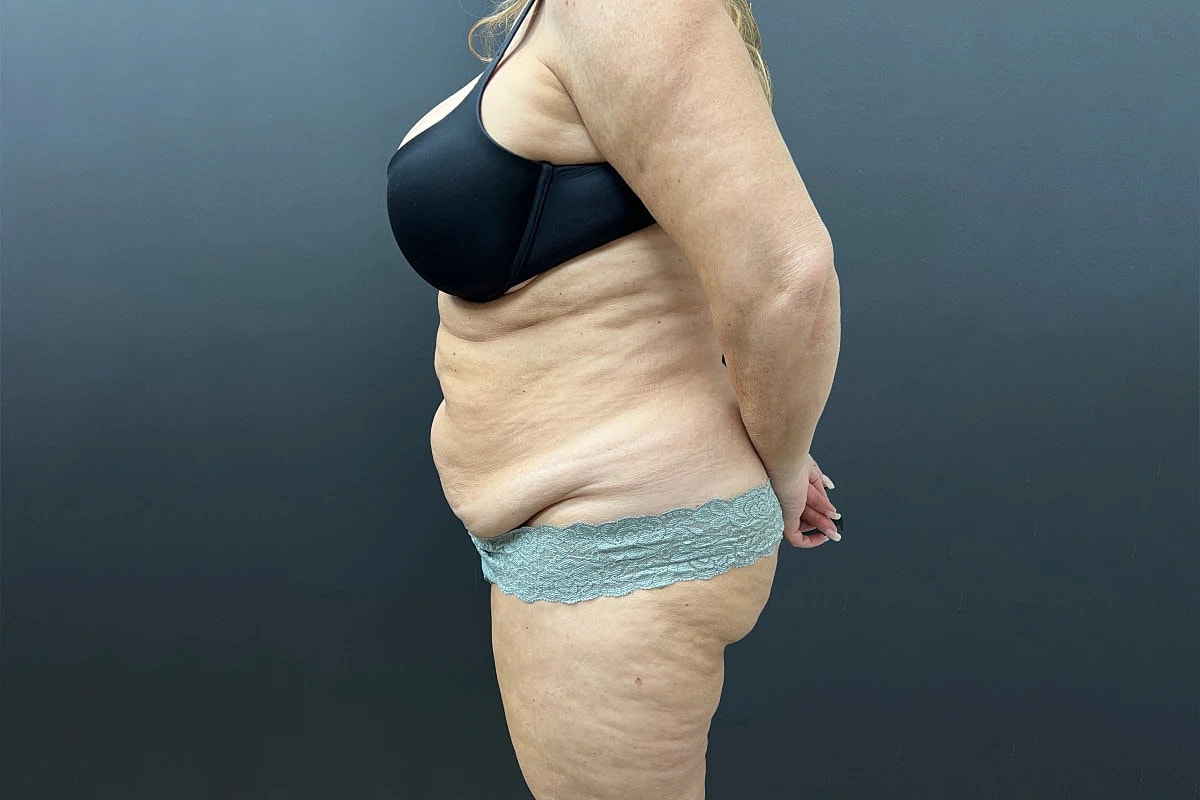 Tummy Tuck Before & After
