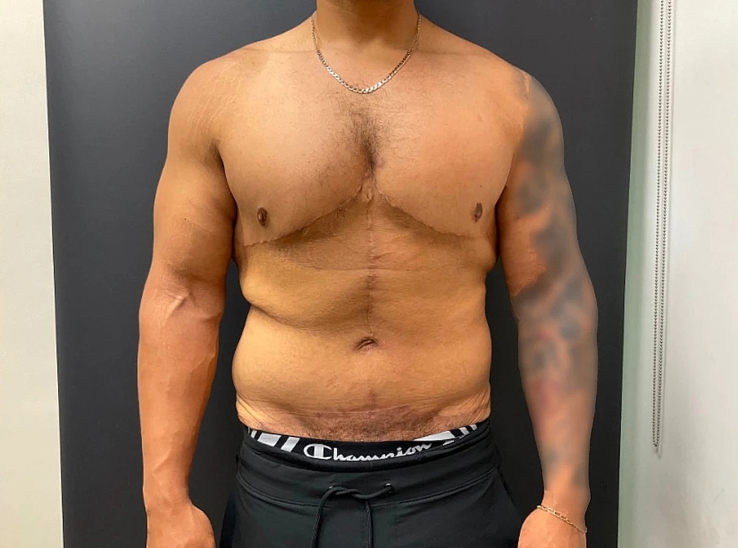 Tummy Tuck Before & After