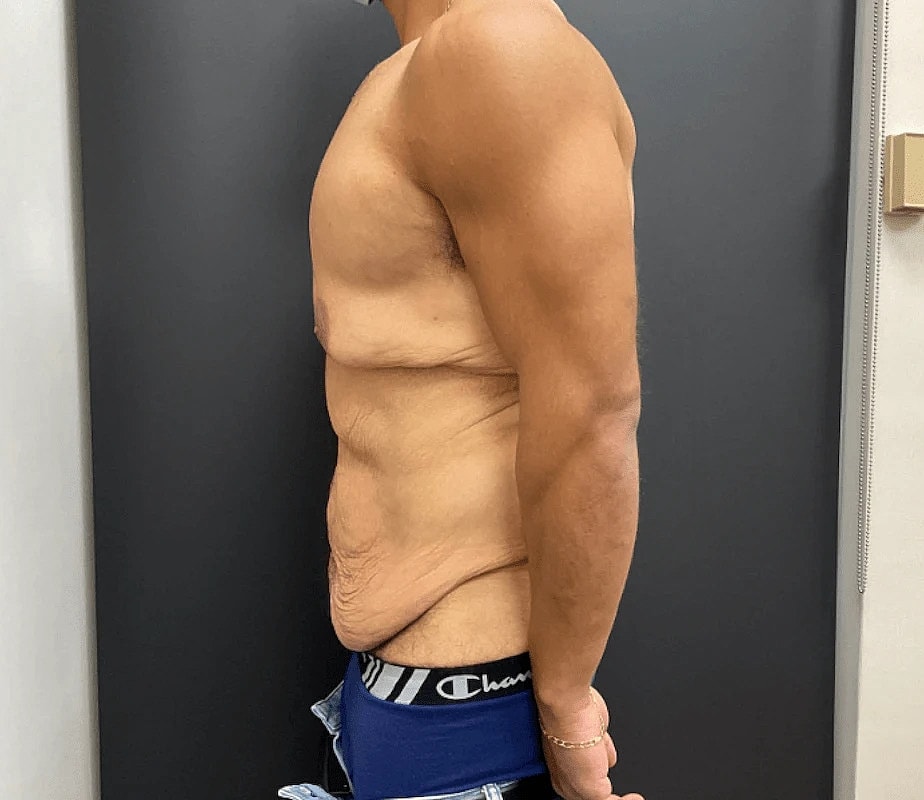 Tummy Tuck Before & After