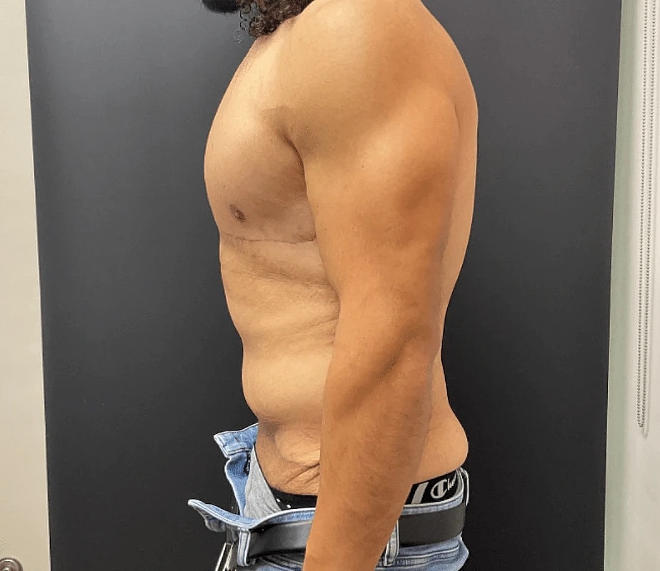 Tummy Tuck Before & After
