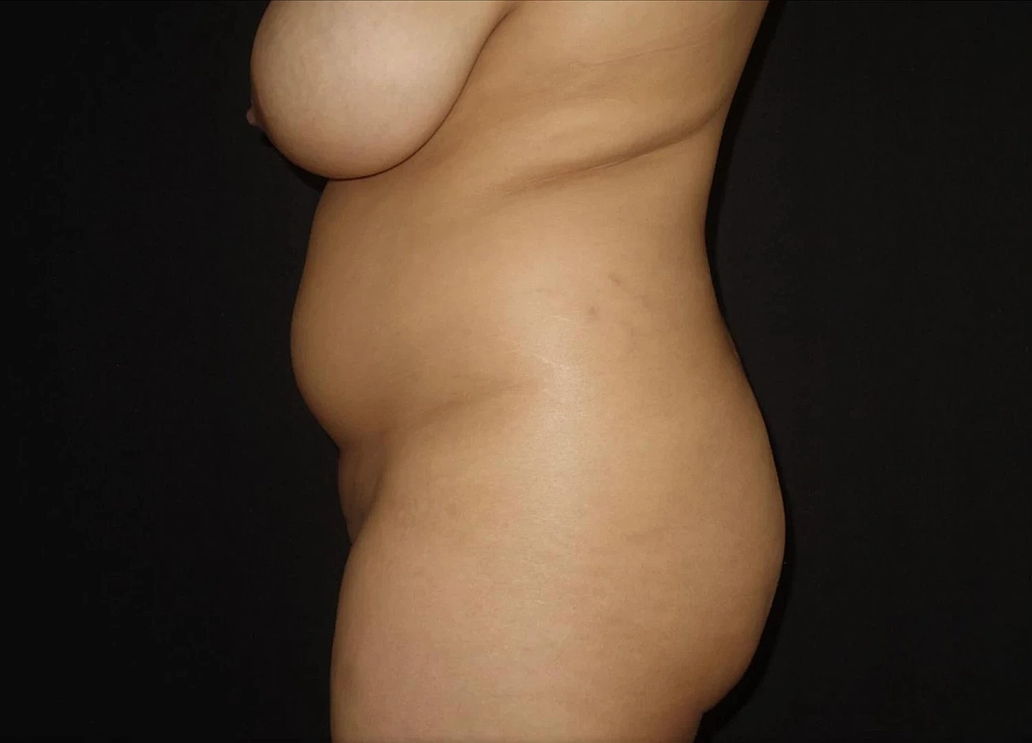 Tummy Tuck Before & After