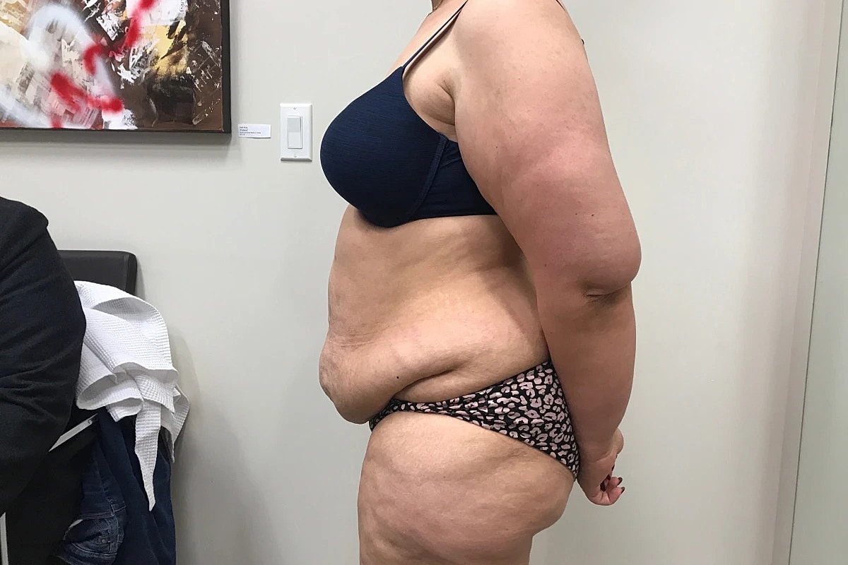 Tummy Tuck Before & After