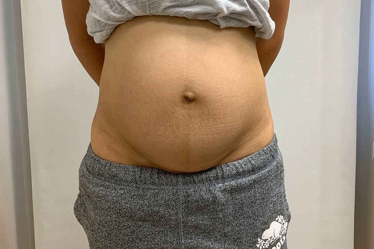 Tummy Tuck Before & After