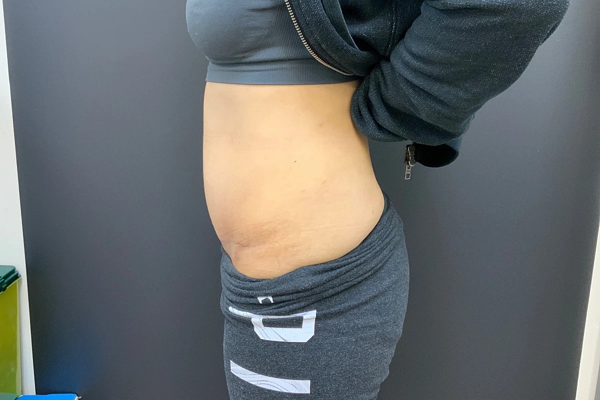 Tummy Tuck Before & After