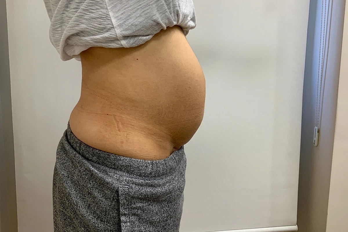 Tummy Tuck Before & After