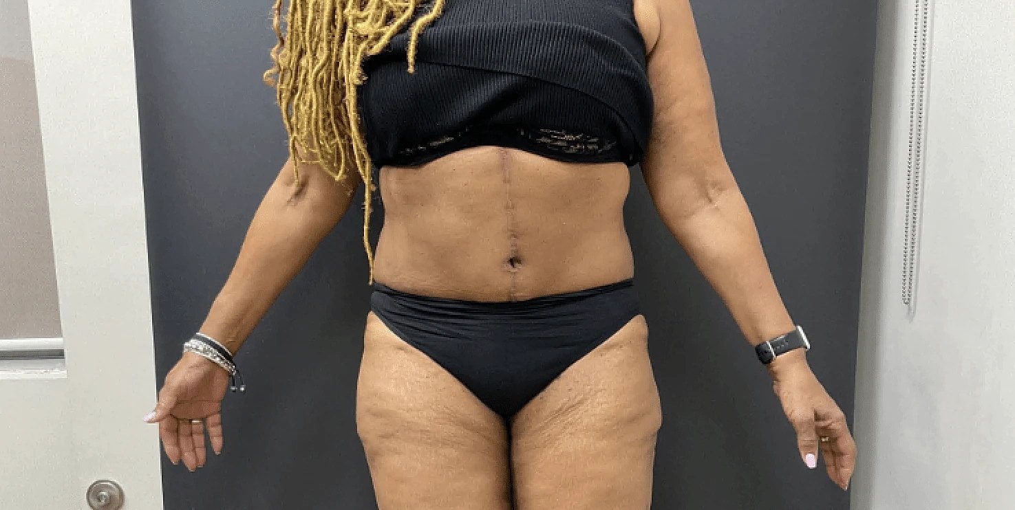 Tummy Tuck Before & After