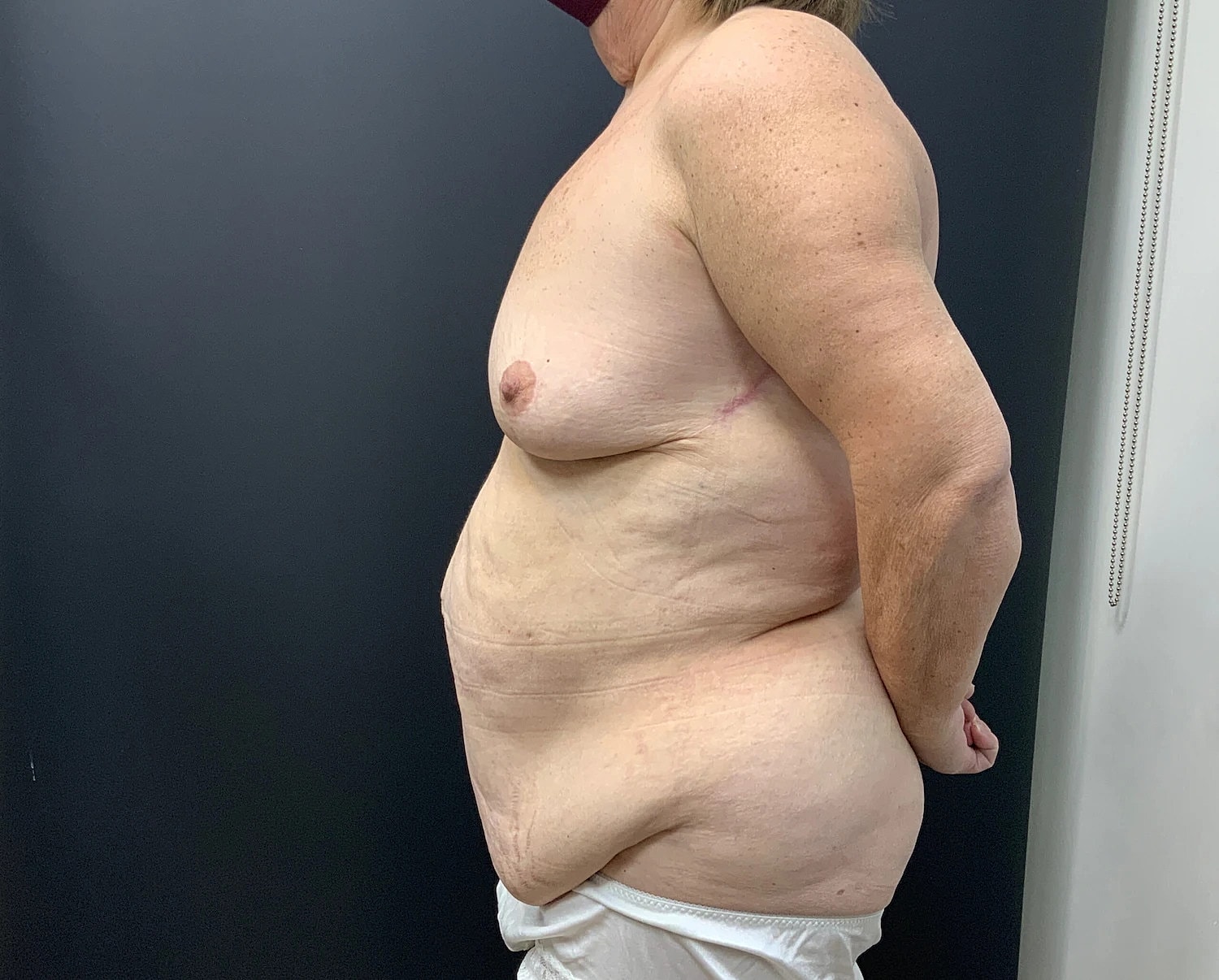 Tummy Tuck Before & After