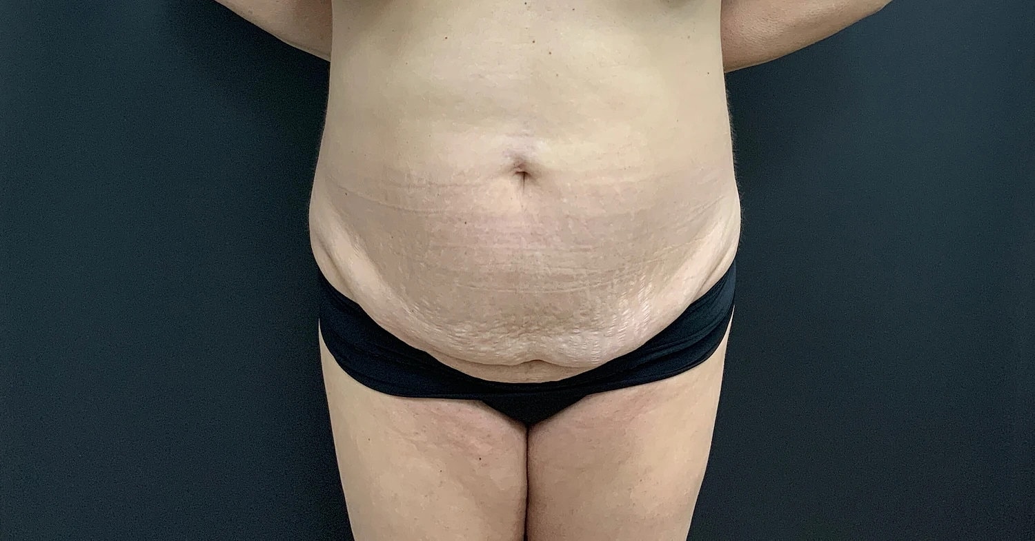 Tummy Tuck Before & After