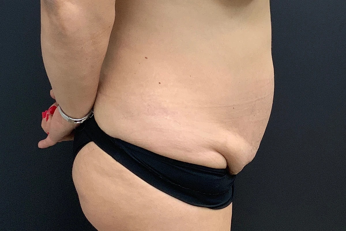 Tummy Tuck Before & After