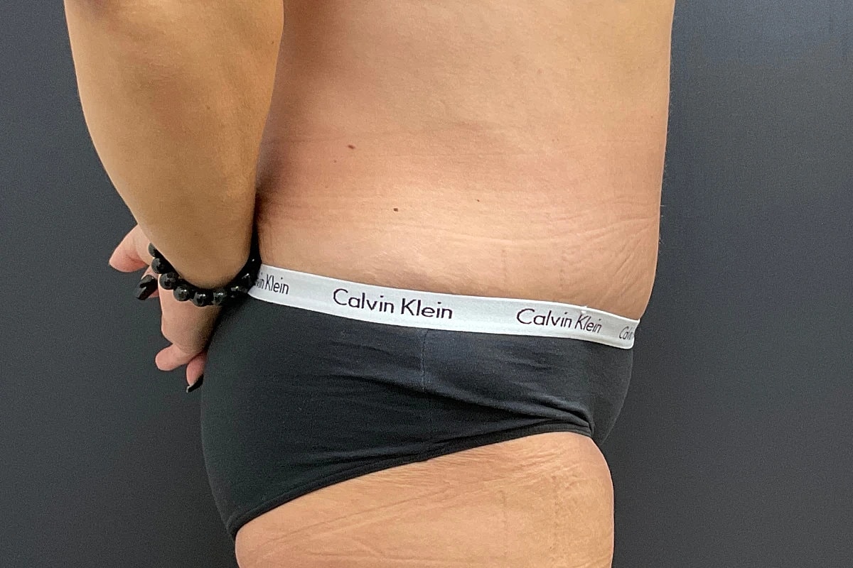 Tummy Tuck Before & After