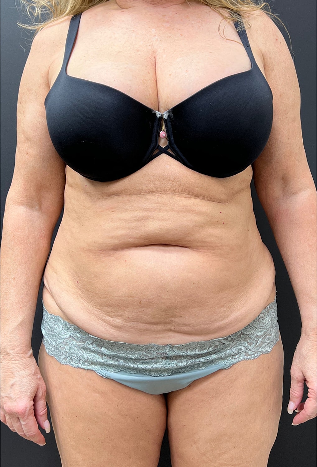 Tummy Tuck Before & After