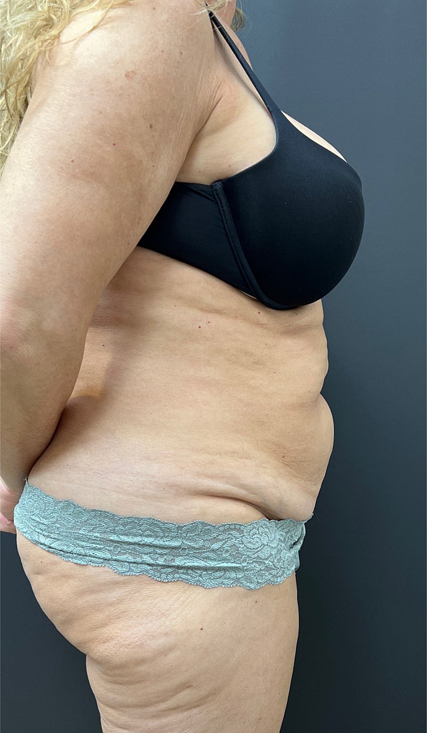 Tummy Tuck Before & After