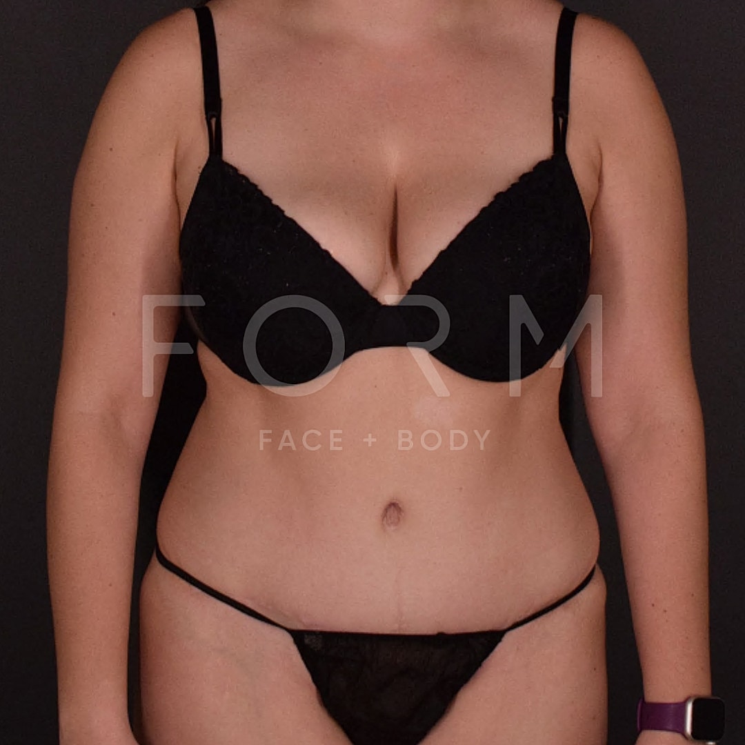 Tummy Tuck Before & After