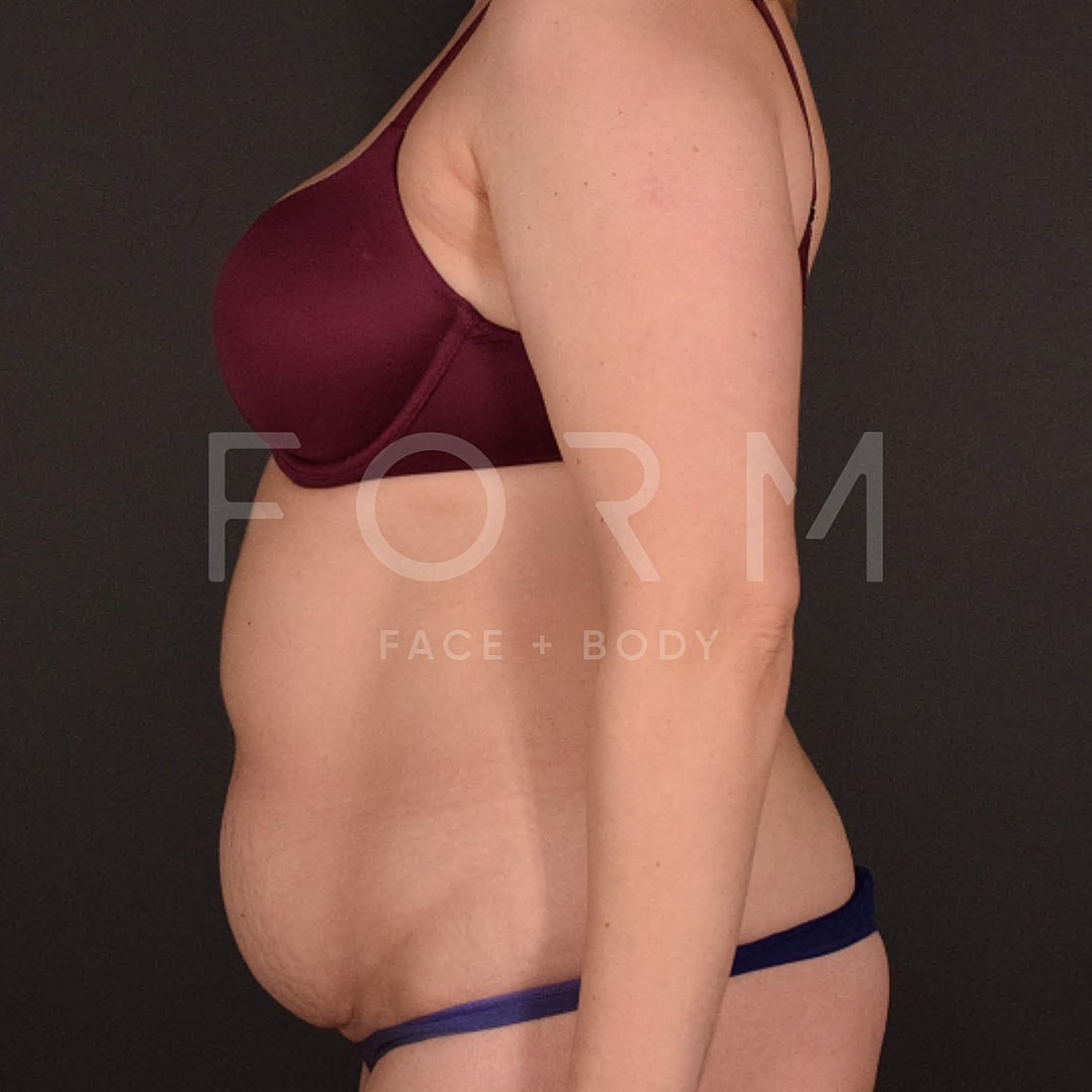 Tummy Tuck Before & After