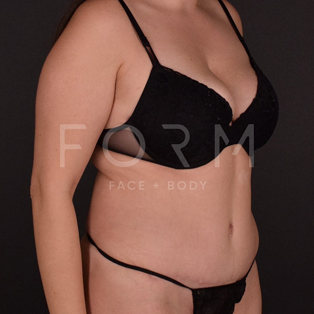 Tummy Tuck Before & After
