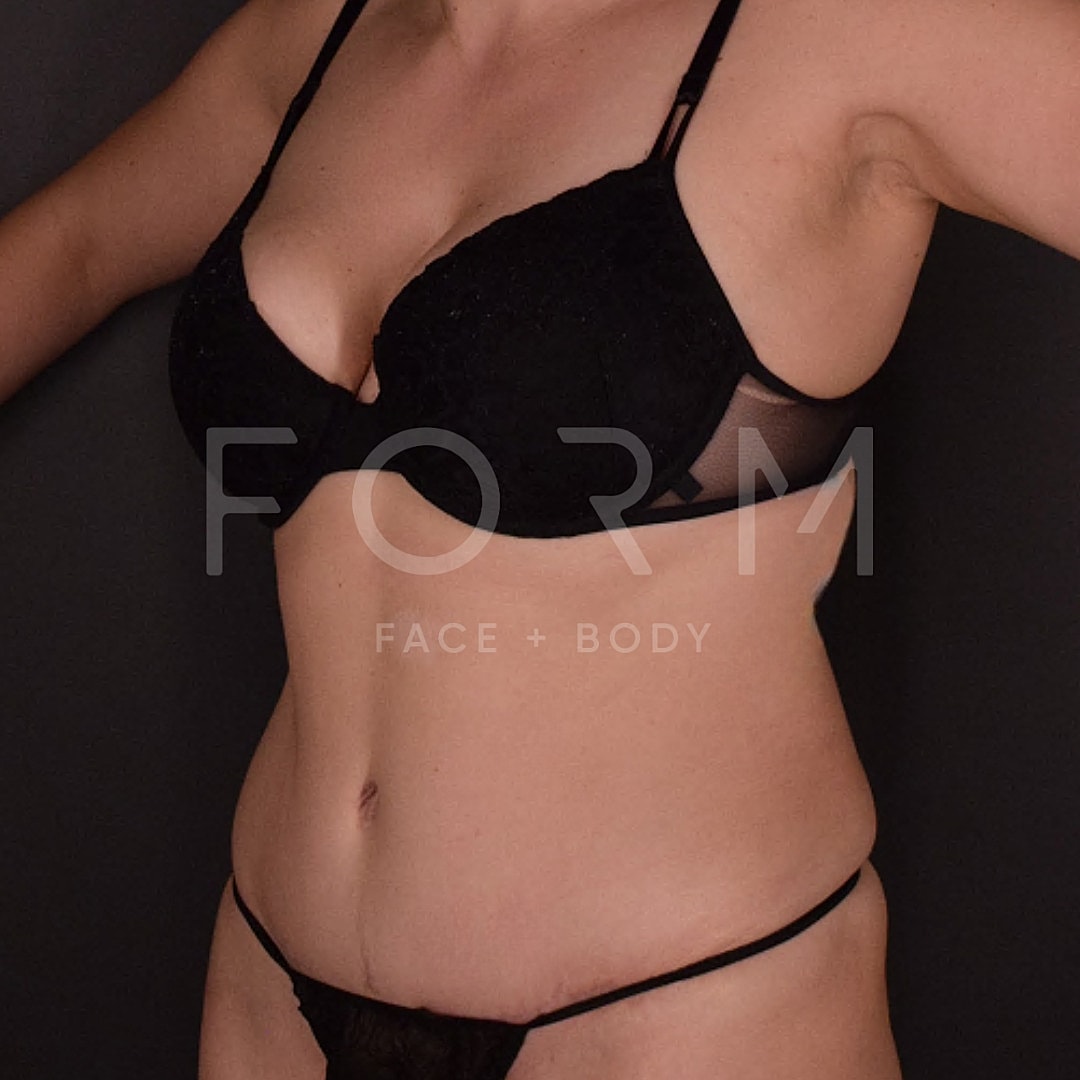 Tummy Tuck Before & After
