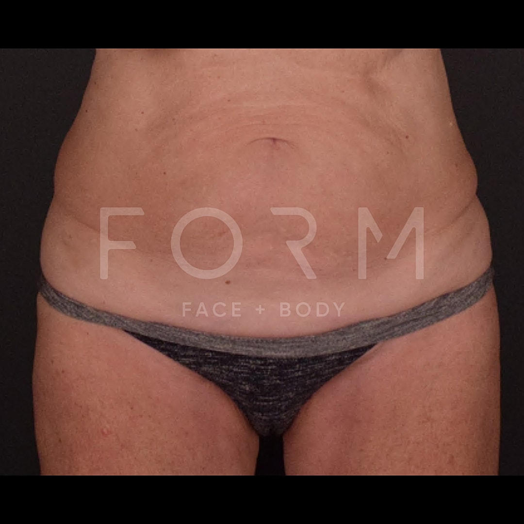 Tummy Tuck Before & After