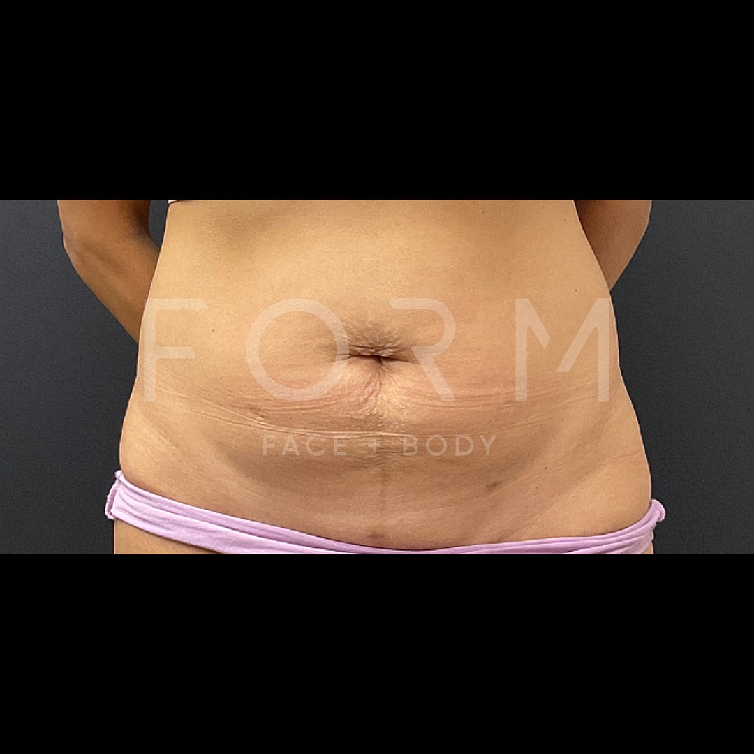 Tummy Tuck Before & After