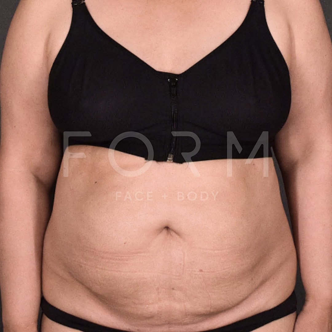 Tummy Tuck Before & After