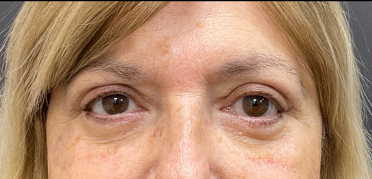 Blepharoplasty Eyelid Surgery Before & After
