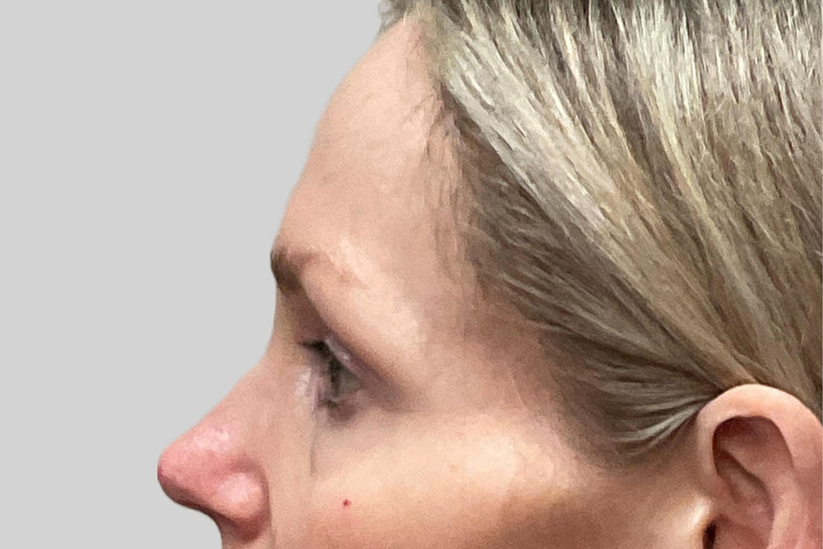 Blepharoplasty Eyelid Surgery Before & After
