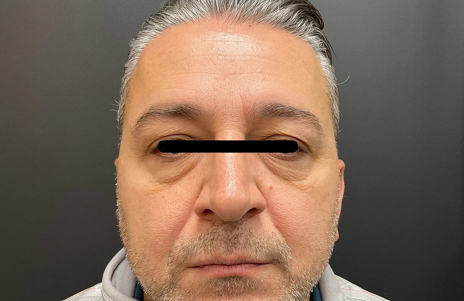 Blepharoplasty Eyelid Surgery Before & After