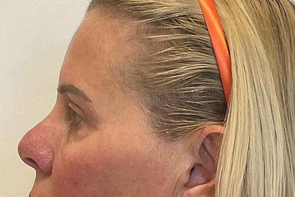 Blepharoplasty Eyelid Surgery Before & After