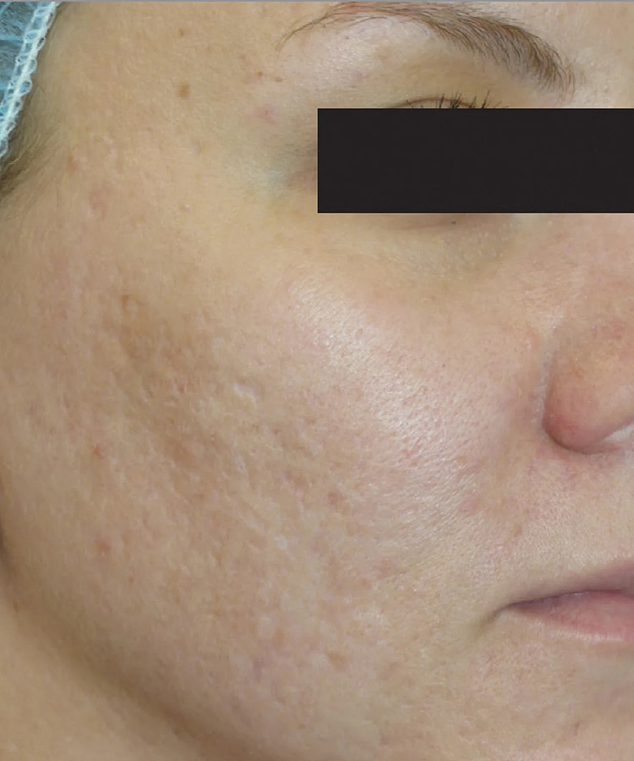 Skin Resurfacing Before & After