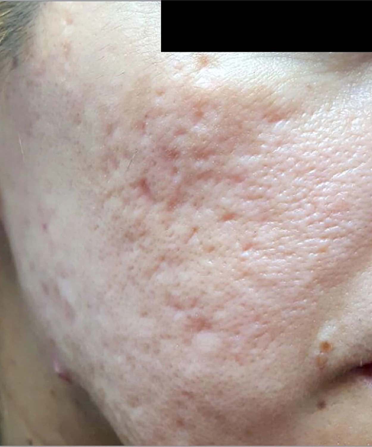 Skin Resurfacing Before & After