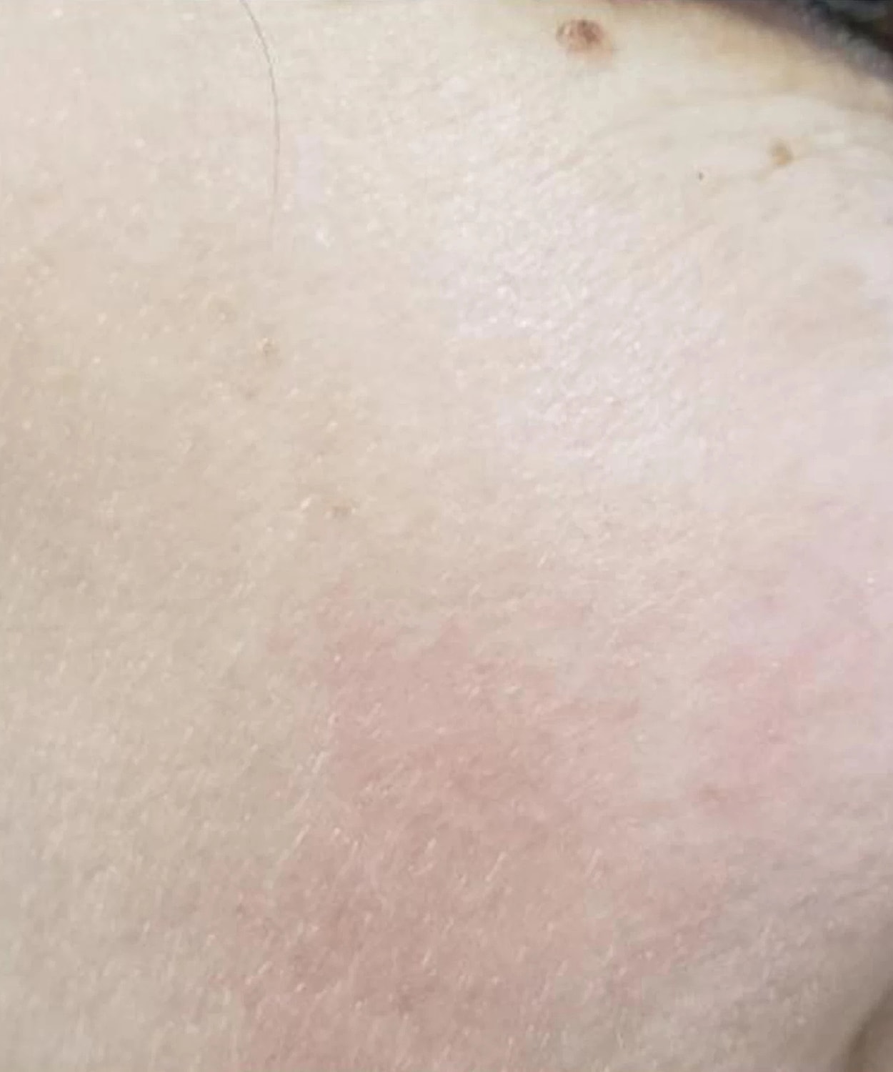 Ipl Before & After