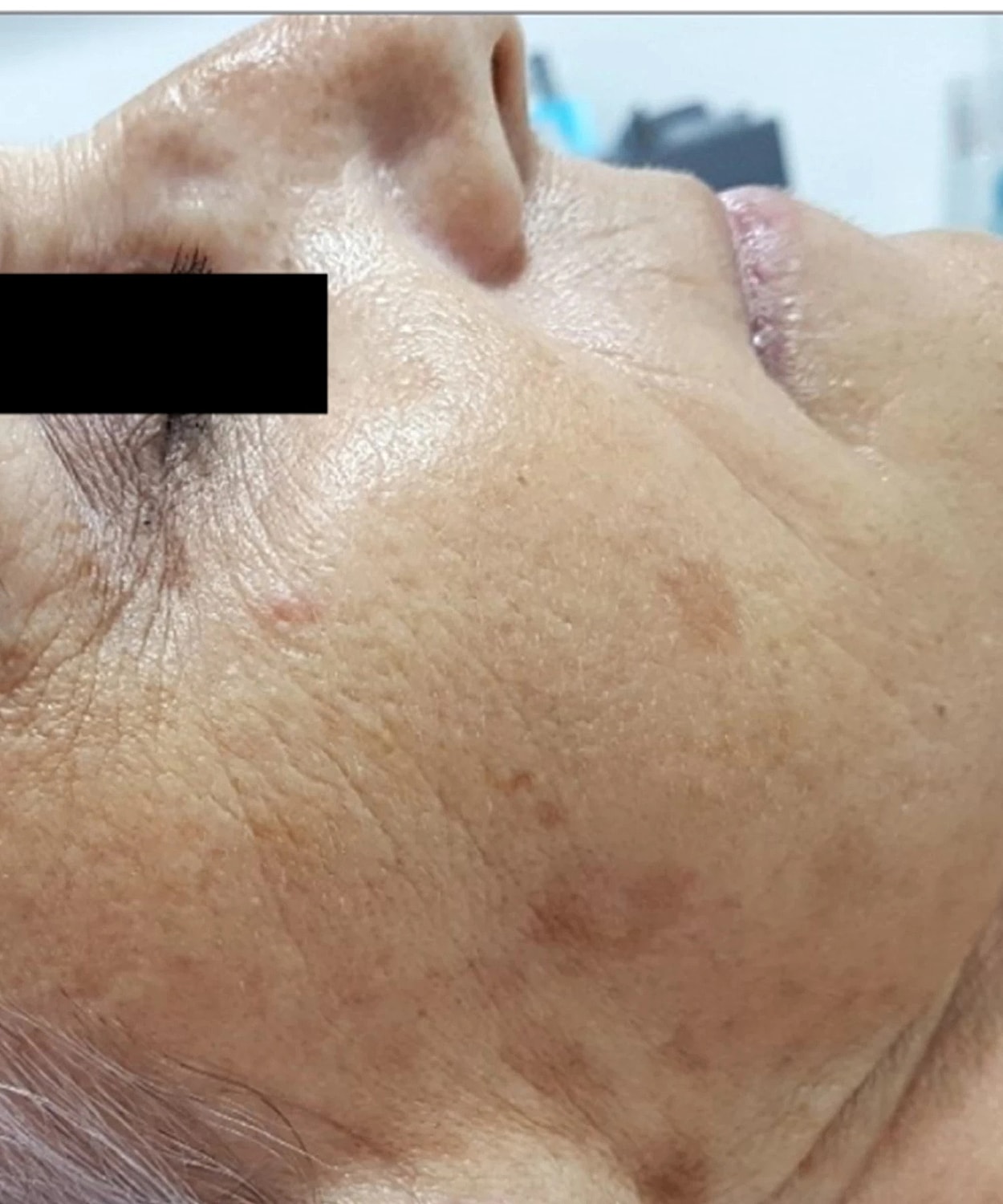 Ipl Before & After