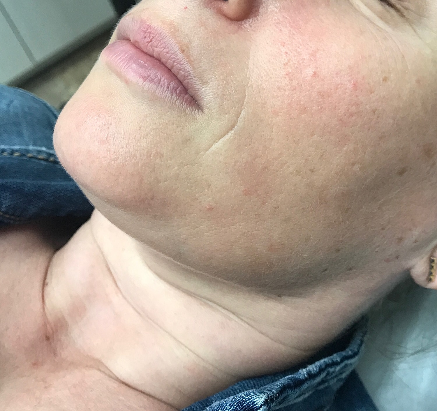 Dermal Fillers Before & After