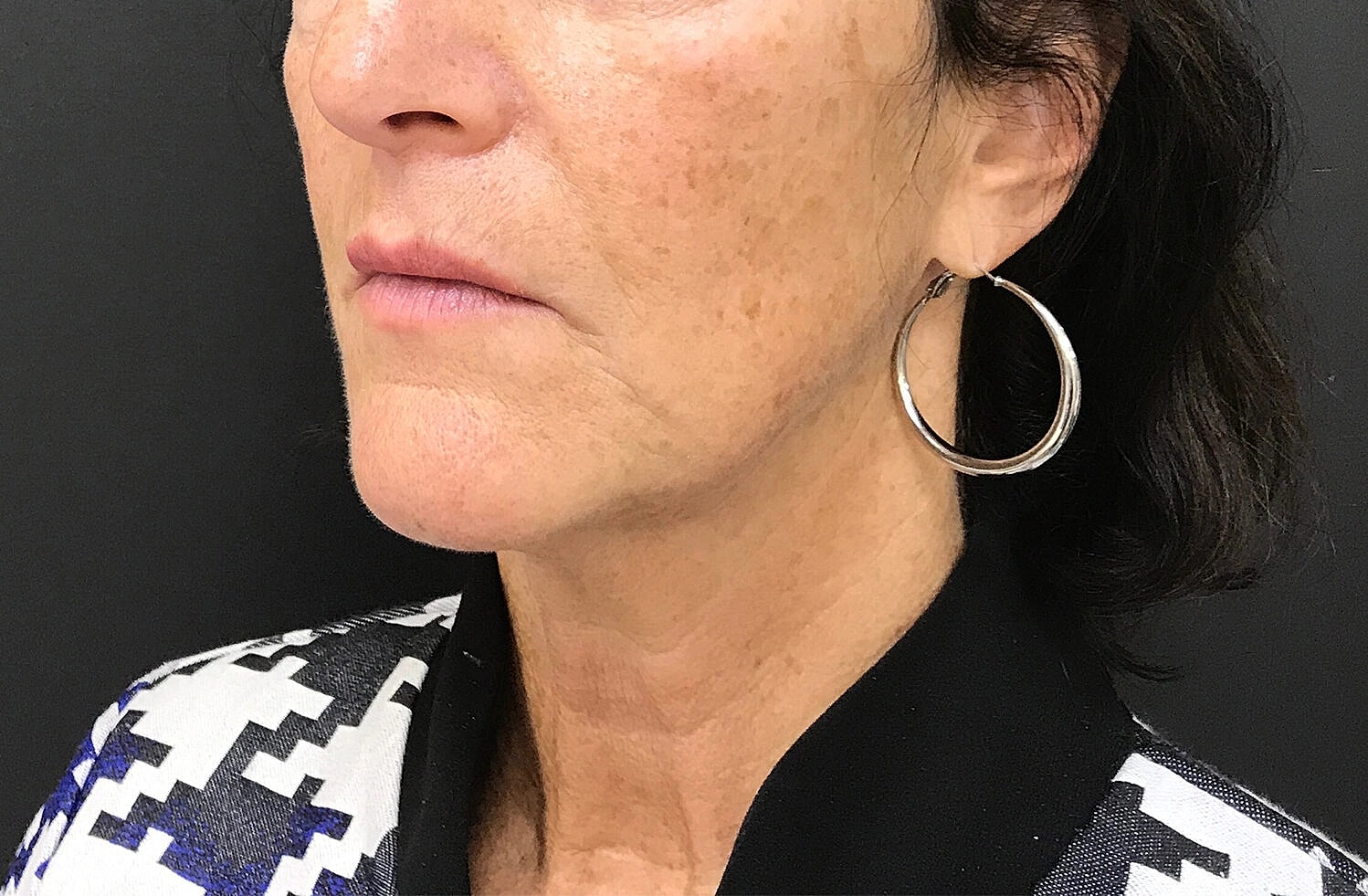 Dermal Fillers Before & After