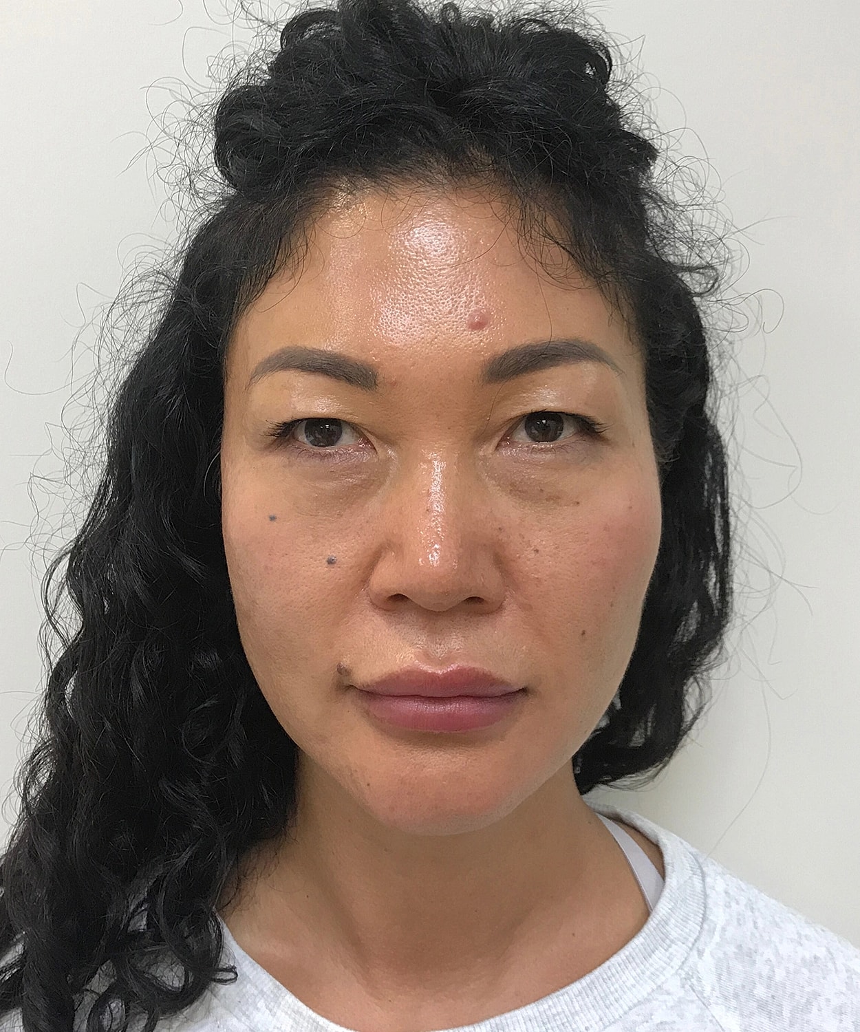 Dermal Fillers Before & After