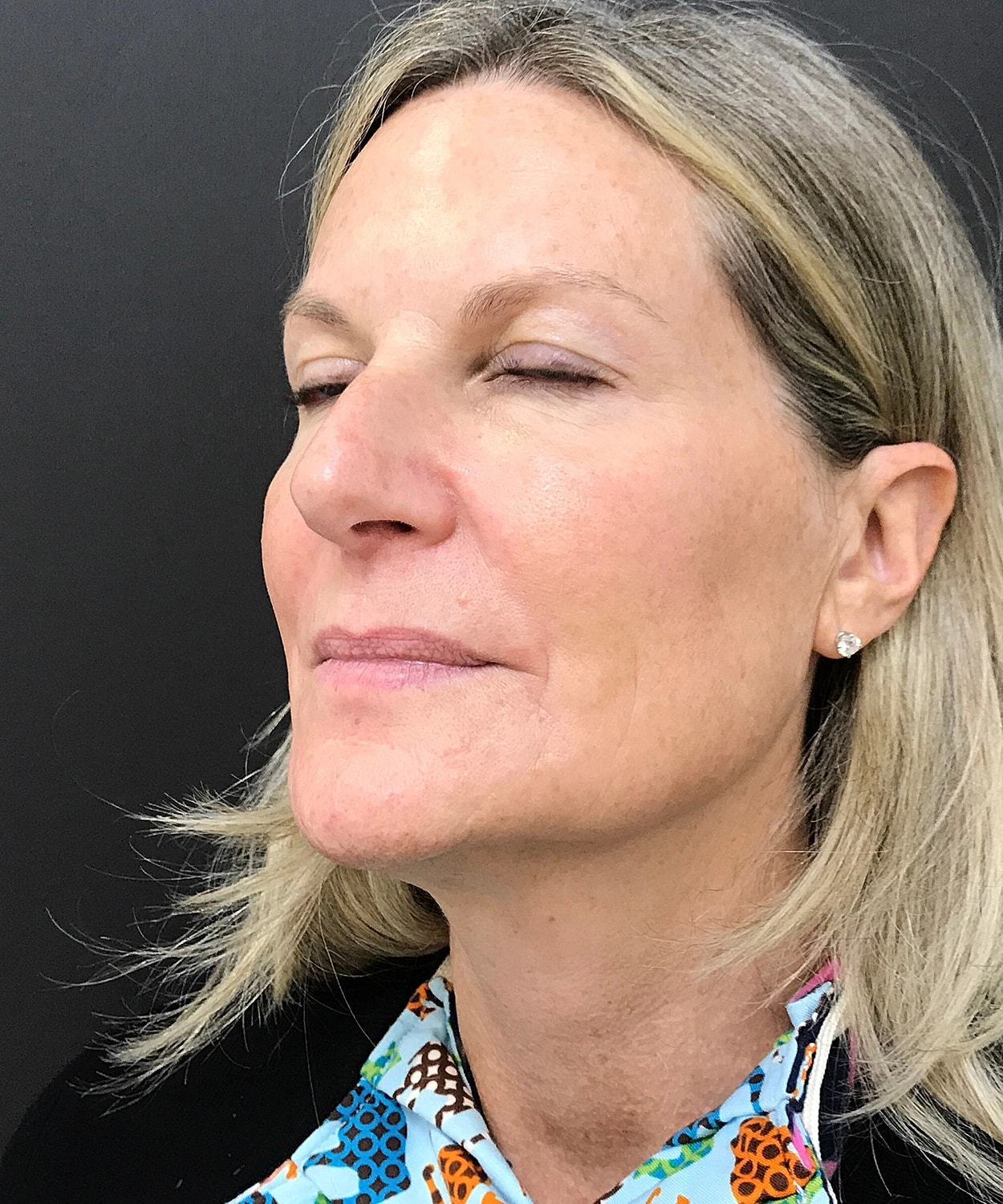 Dermal Fillers Before & After