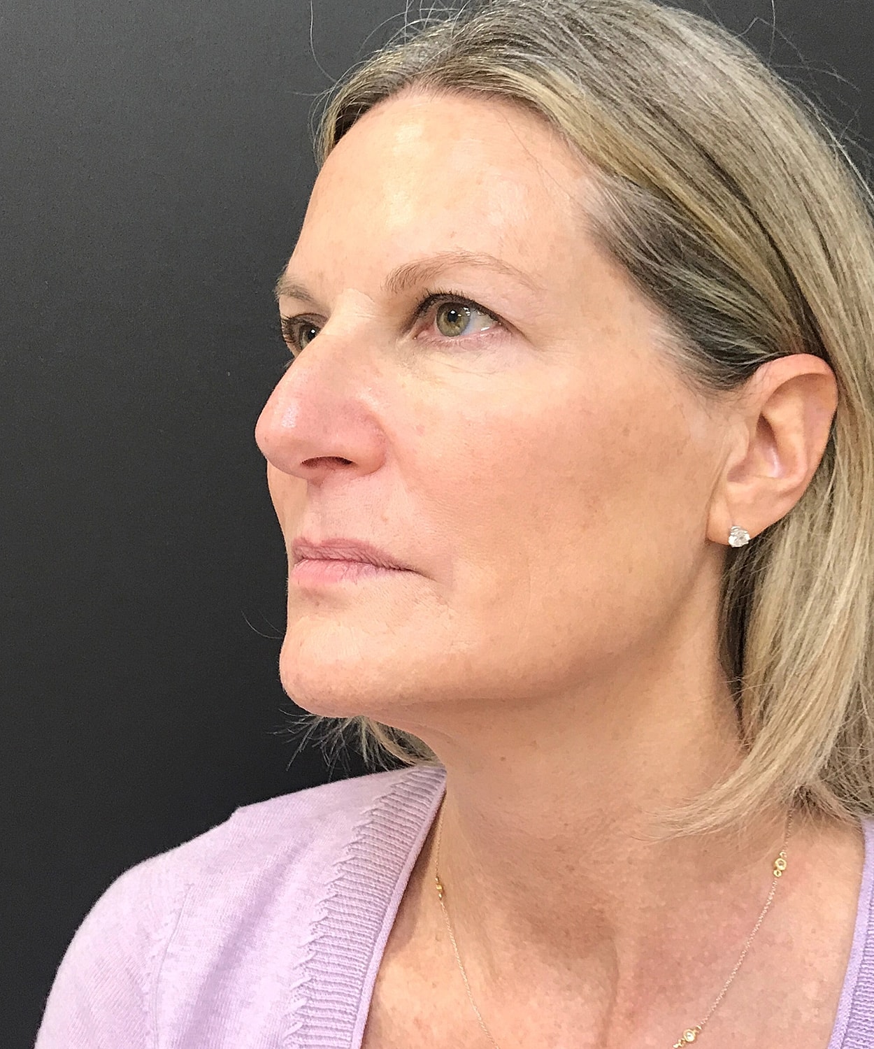 Dermal Fillers Before & After