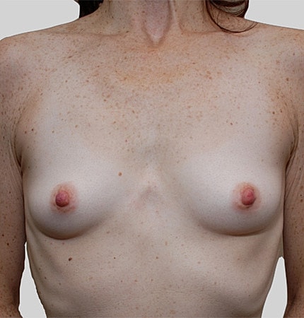 Breast Augmentation Before & After