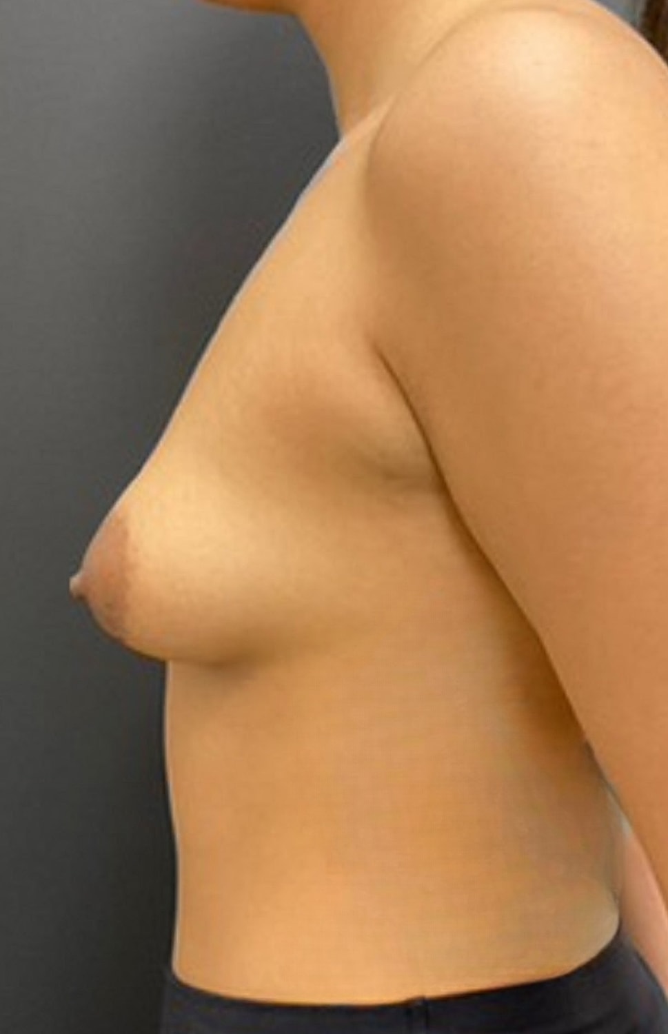 Breast Augmentation Before & After