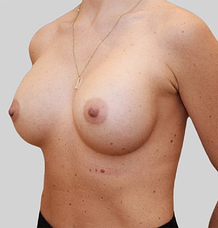 Breast Augmentation Before & After