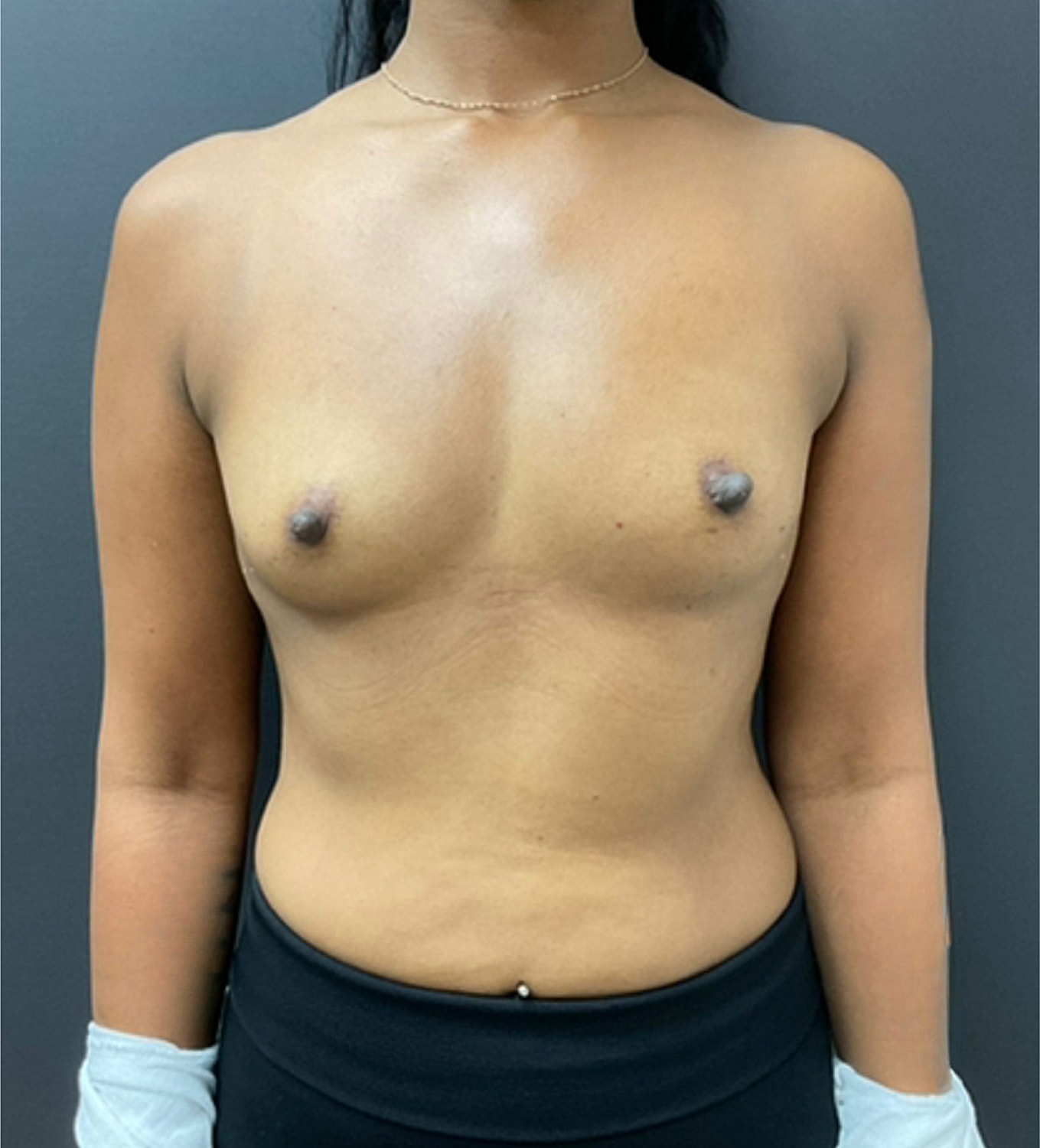Breast Augmentation Before & After