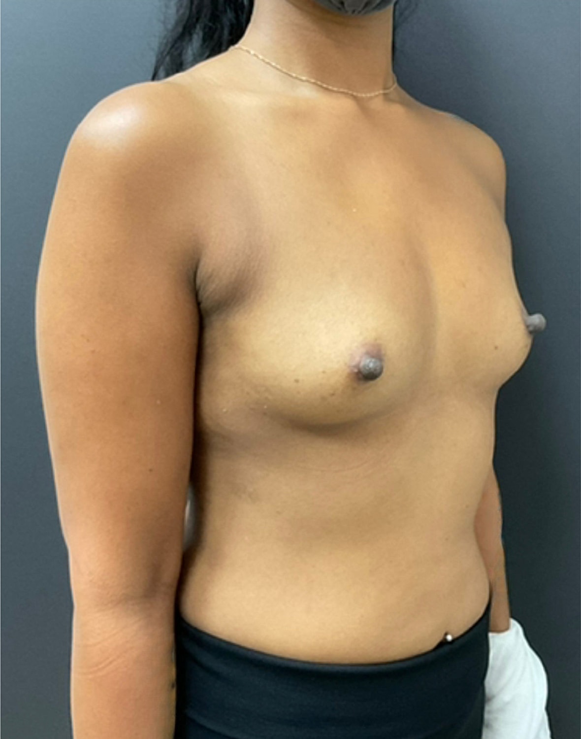 Breast Augmentation Before & After