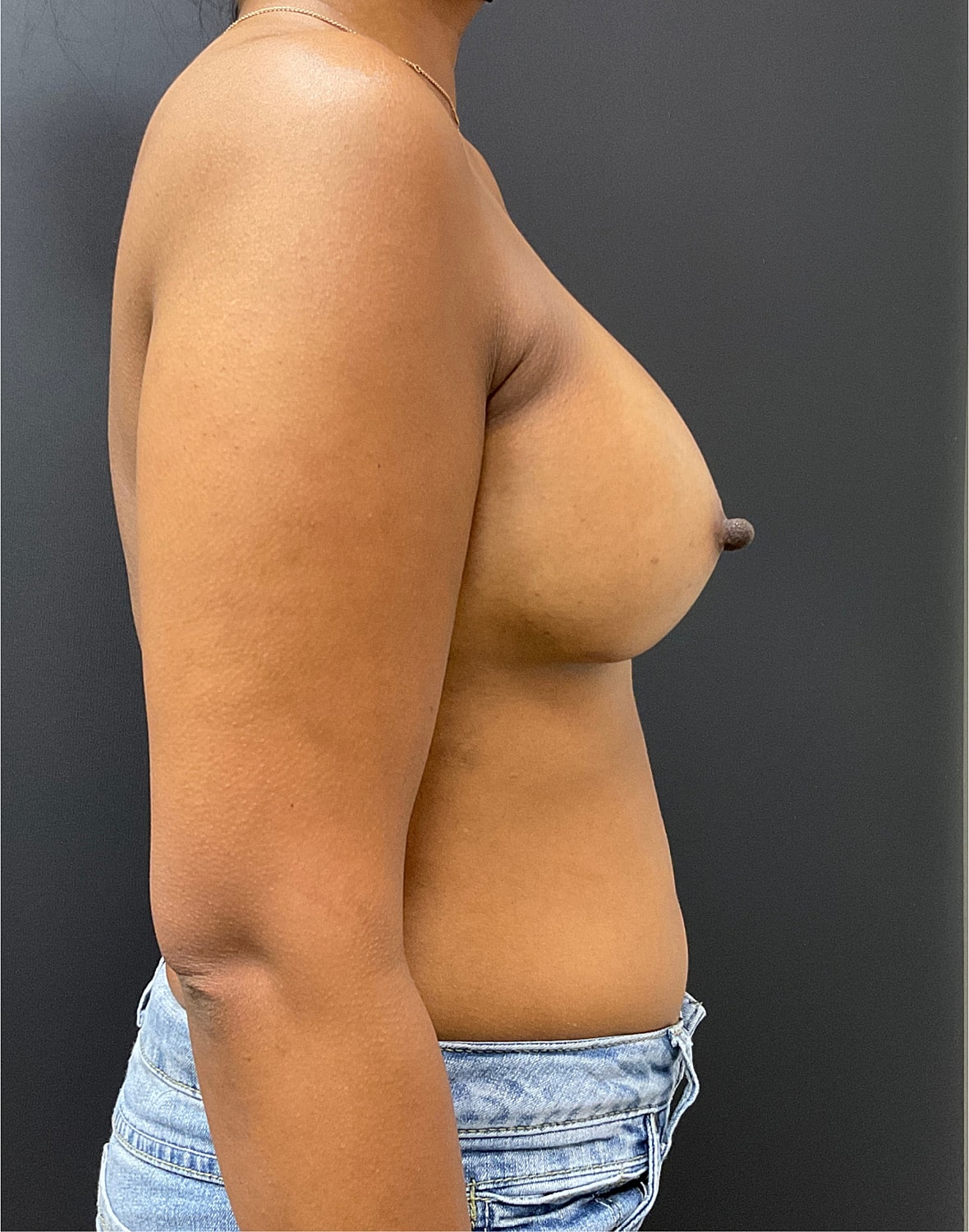 Breast Augmentation Before & After