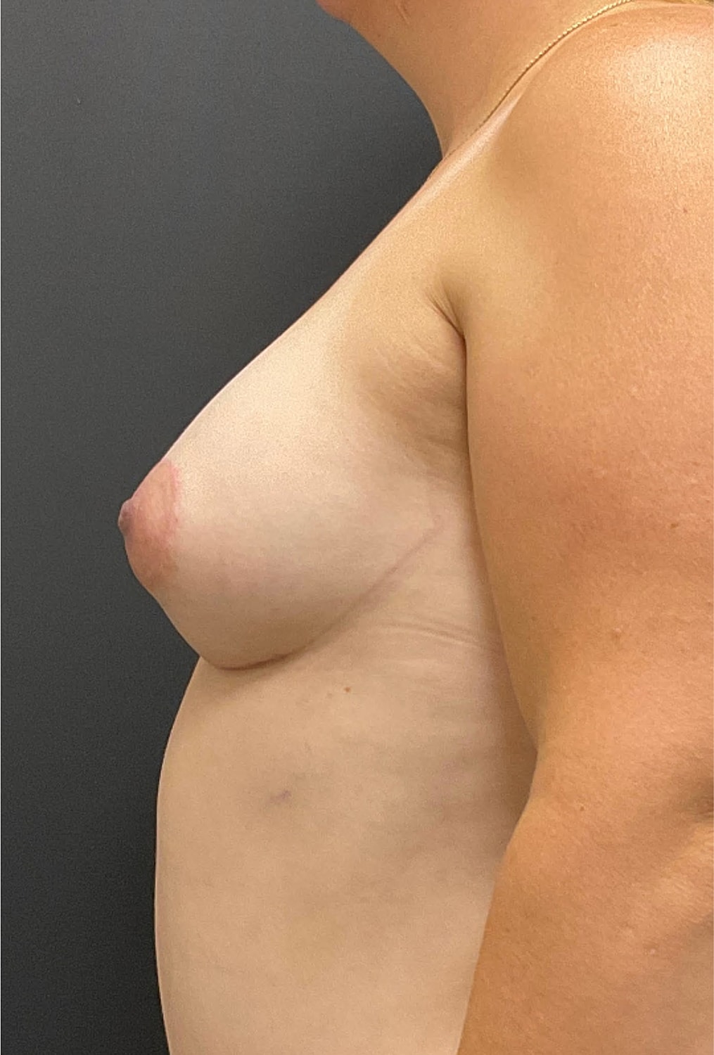 Breast Augmentation Before & After