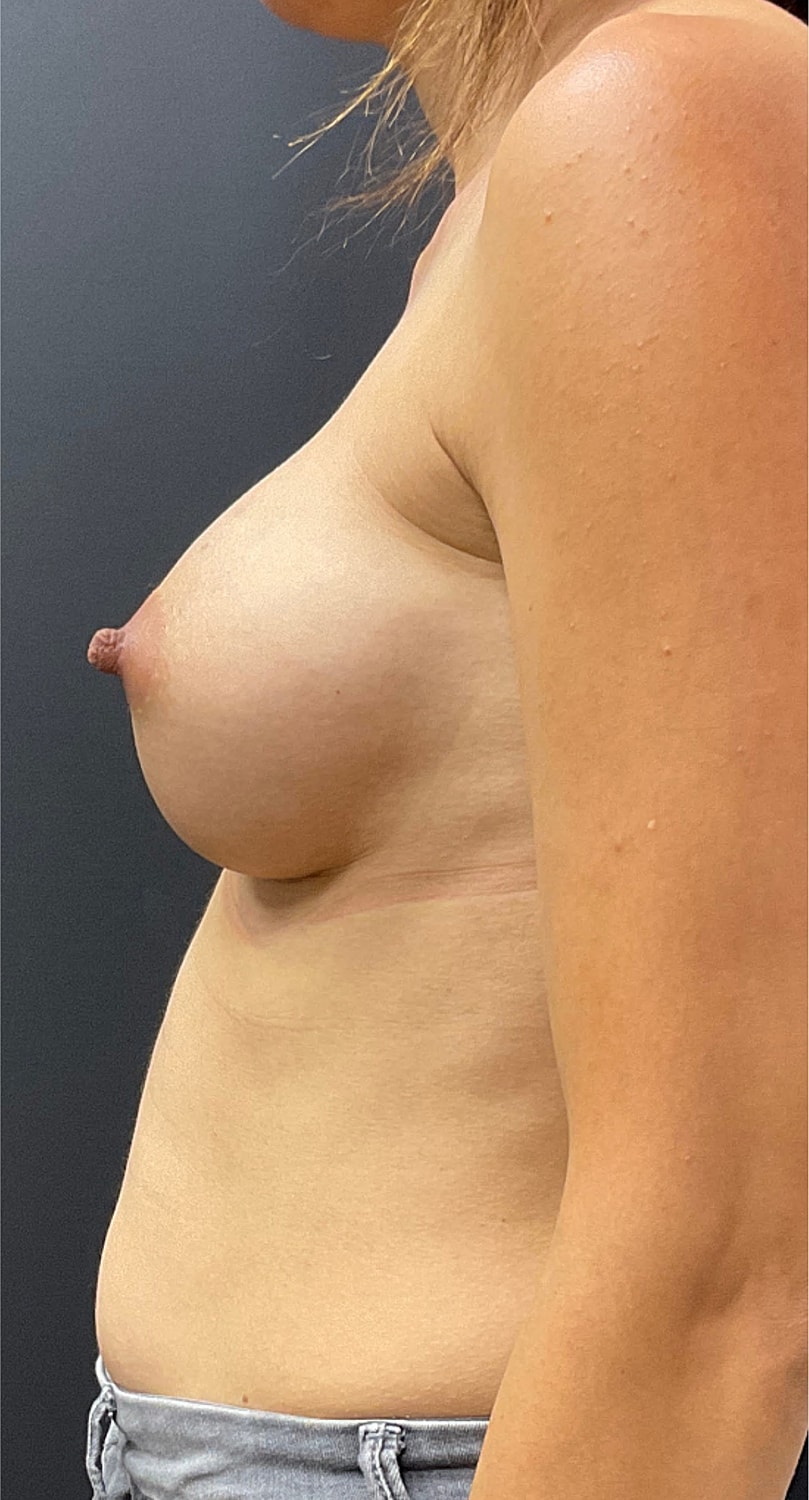 Breast Augmentation Before & After