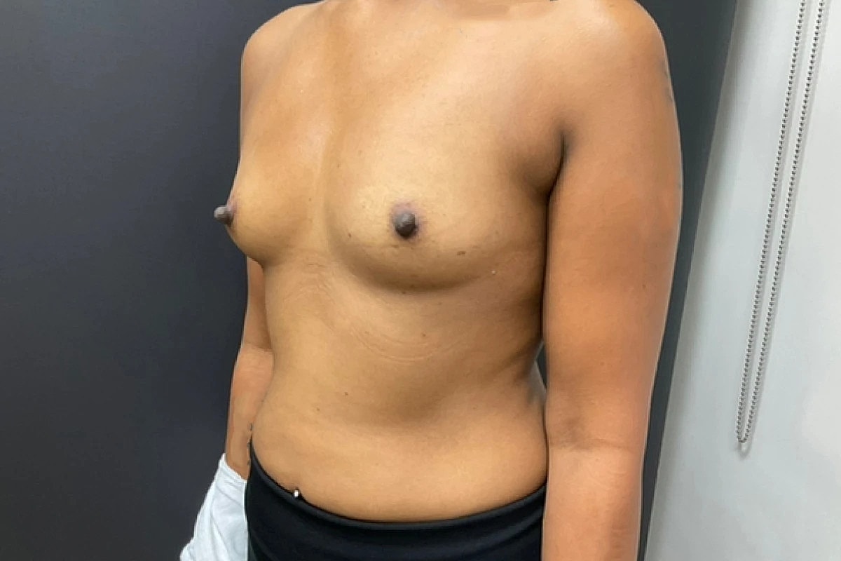 Breast Augmentation Before & After