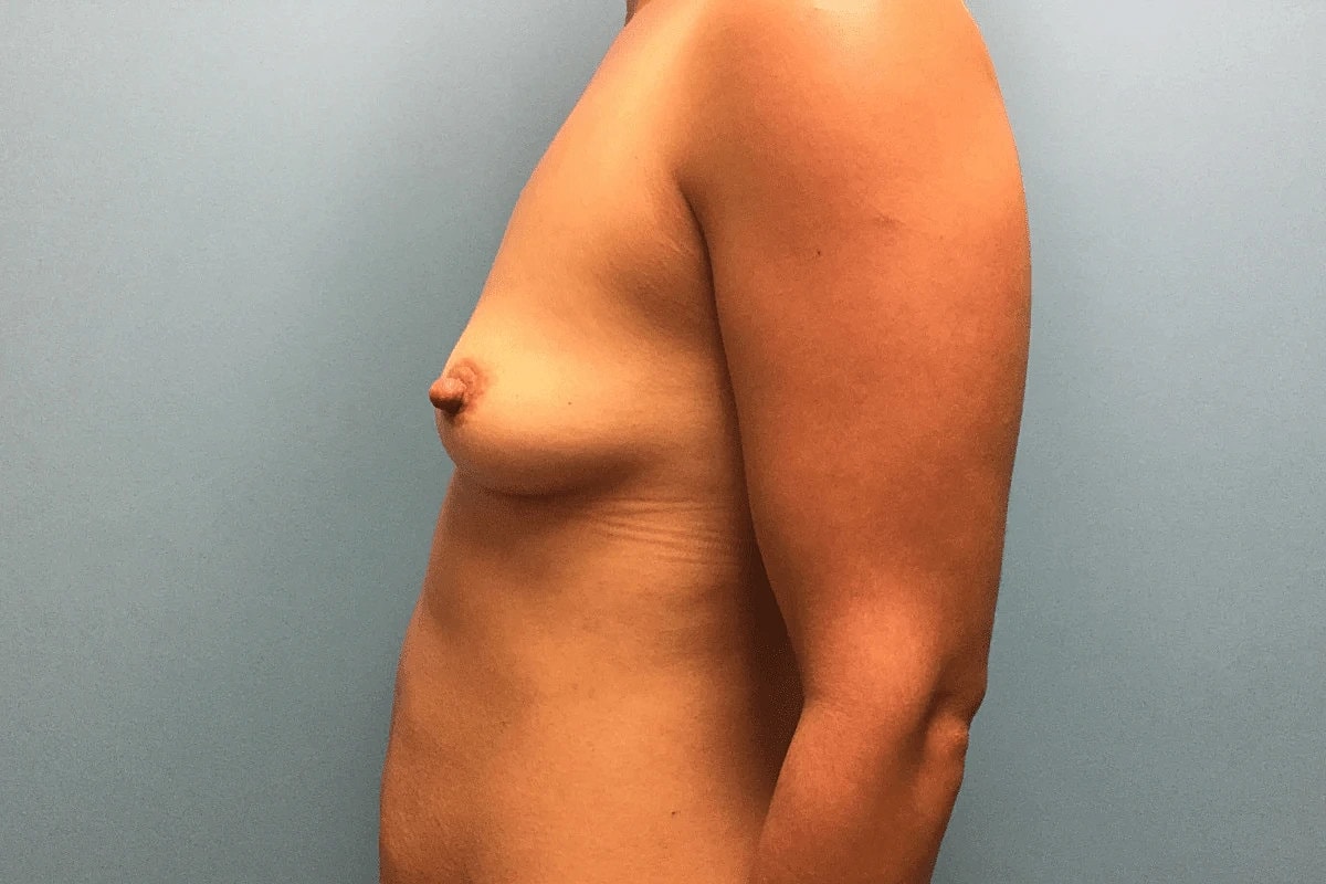 Breast Augmentation Before & After