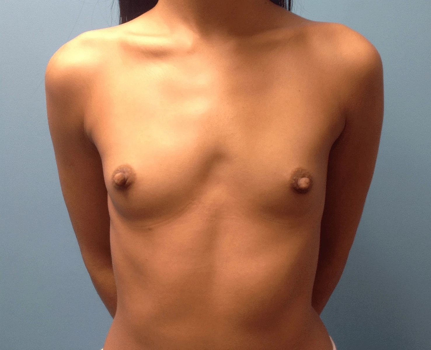 Breast Augmentation Before & After