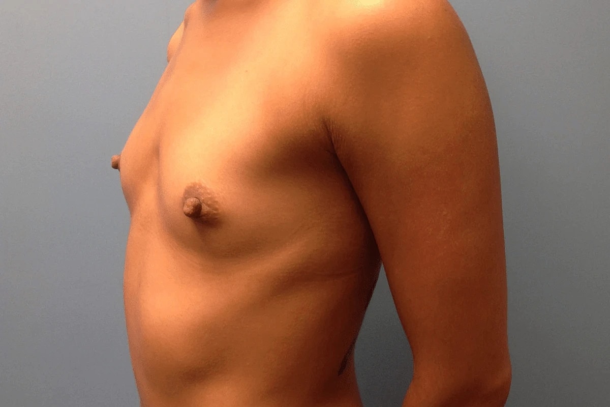 Breast Augmentation Before & After